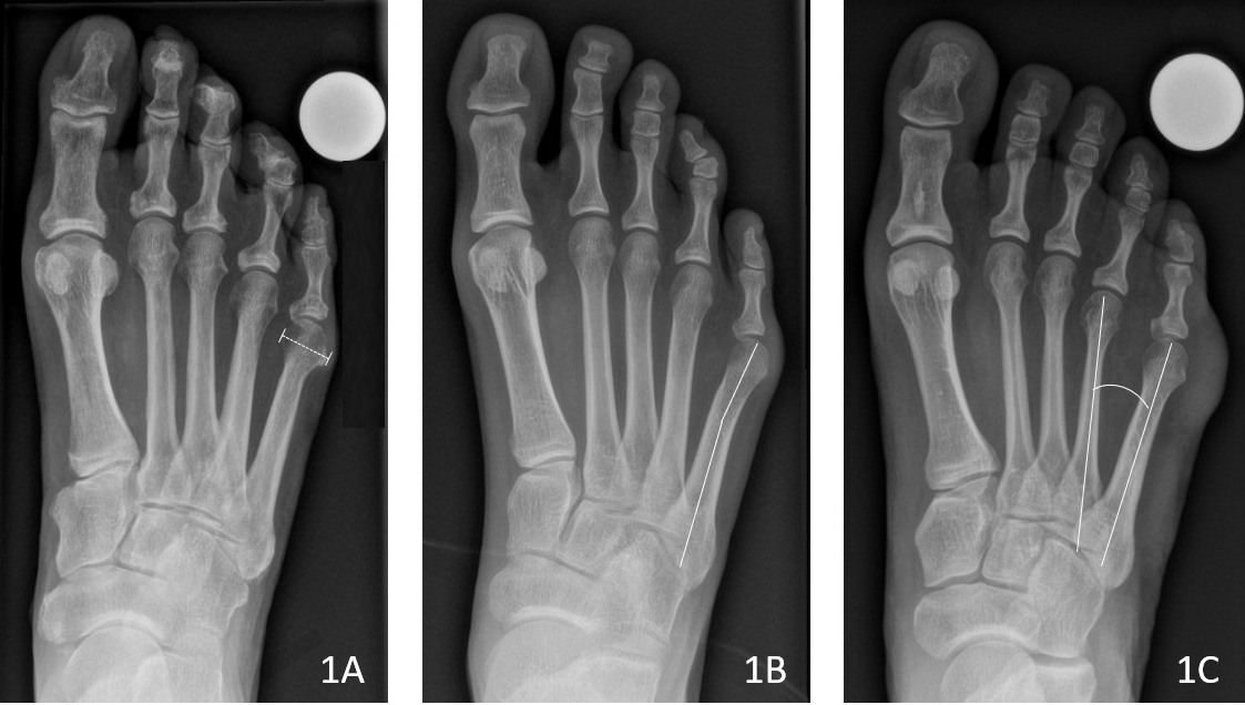 Drei Röntgenaufnahmen von Fuss-Deformitaetstypen.