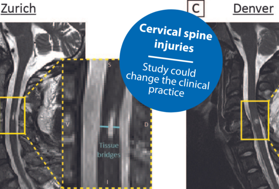 Tissue bridges in cervical spinal cord injury